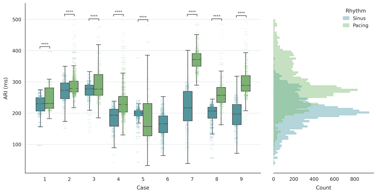 ARI distributions during sinus rhythm and pacing, shown for individual cases and across the cohort. Brackets mark differences with p < 0.0001.